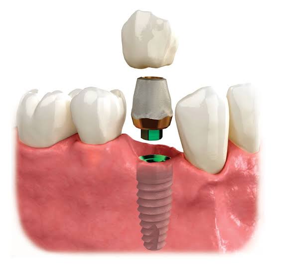 Single and multiple tooth implants