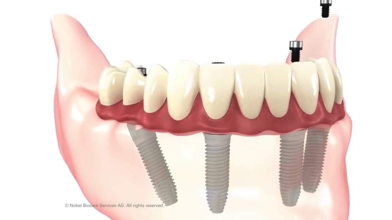 All-on-4® Implants