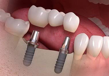All-On-4® Implants