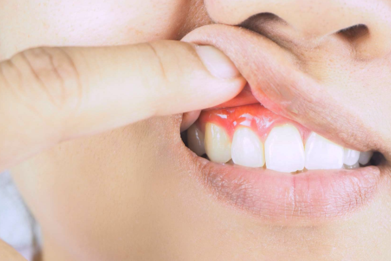 How to identify if you have gum disease?