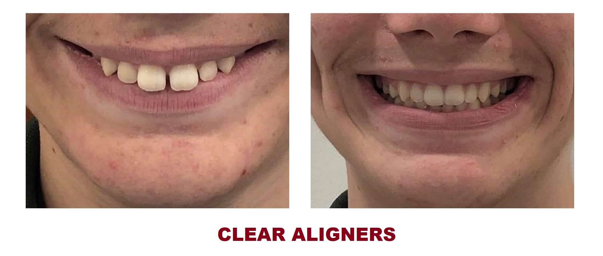 CLEAR ALIGNERS